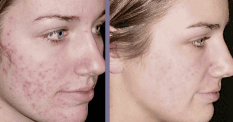 Чим відрізняється вакуумна чистка обличчя від інших аналогічних процедур, відгуки та результати після сеансів