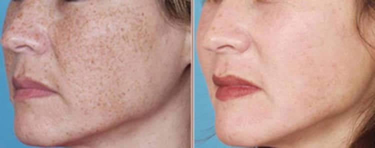 Ефективність і переваги фракційної мезотерапії для шкіри обличчя