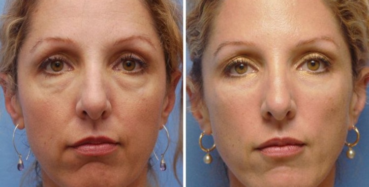 Застосування філлеров під очима і в області носослезной борозни, фото до і після інєкцій молодості