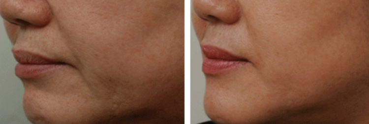 Ефективність і переваги фракційної мезотерапії для шкіри обличчя