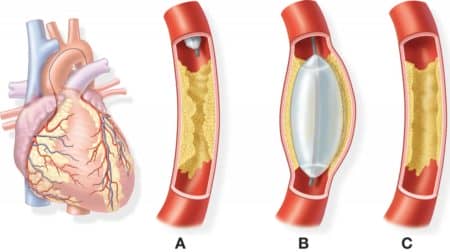 Що необхідно знати про стентування судин серця?