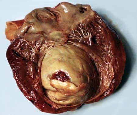 Особливості діагностики та лікування трансмурального інфаркту міокарда