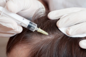 Плазмотерапия: можливості плазми для лікування та відновлення волосся
