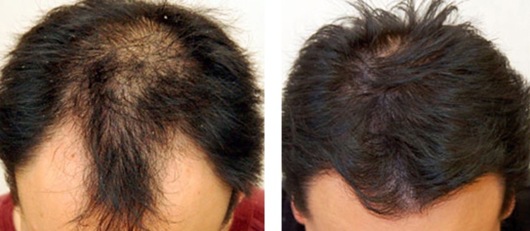 Плазмотерапия: можливості плазми для лікування та відновлення волосся