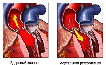 Симптоми і лікування аортальної регургітації у першій ступеня