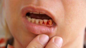 До чого сняться зуби, які випадають з кровю? ТРИВОЖНИЙ ЗНАК! Безкровне випадання зубів у сні