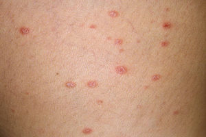 Хвороба шкіри псоріаз, від чого виникає і як проявляється (фото)