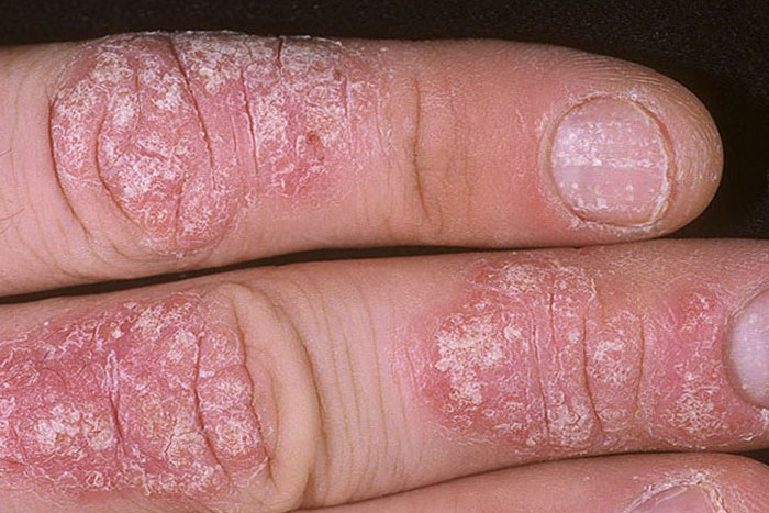 Псоріаз на пальцях рук, симптоми і лікування псоріазу кінцівок