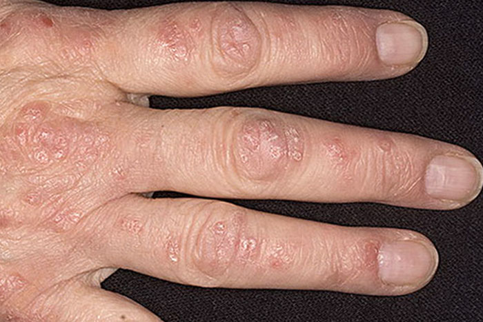 Псоріаз на пальцях рук, симптоми і лікування псоріазу кінцівок
