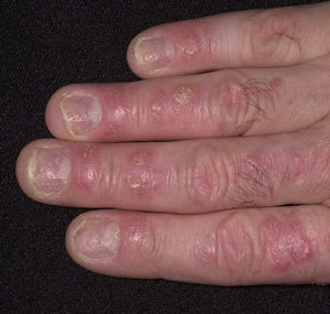 Псоріаз нігтів, лікування та різновиди такого захворювання (фото)