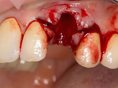 Після видалення зуба: болі ниючі, сильні, фантомні, що робити, дуже сильно болить і є великий згусток крові