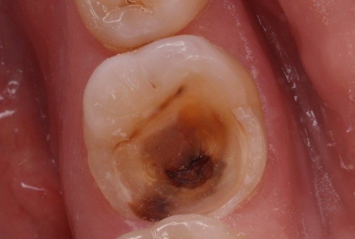 Запалення пульпіту. Симптоми і причини запалення пульпи зуба.