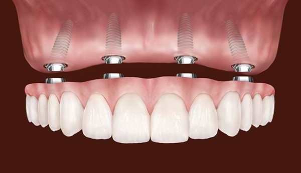 Протезування при повній відсутності зубів