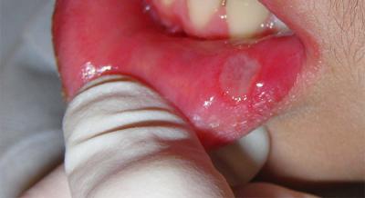 Стоматит на губах у дорослих: на внутрішній стороні, фото нижній, ніж лікувати, всередині в носі як вилікувати, ніж припекти у роті