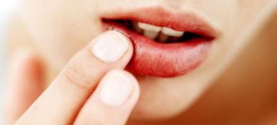 Мазь від стоматиту: чим помастити в роті у дорослих, гелі та креми для лікування, ніж мазати   Калгелем, Нистатиновой маззю, Лидохлором