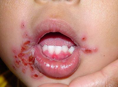 Стоматит: симптоми і лікування у дітей перші ознаки у роті на фото, як проявляється у дитини 2 років, дитяча профілактика