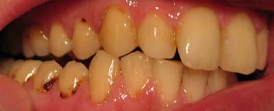 Пульпіт хронічний і гострий: МКБ 10, що це таке, симптоми, лікування, скарги, загострення, EDI, диференціальна діагностика зуба