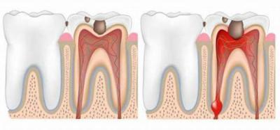 Антибіотики при пульпіті зуба: лікування у дорослого
