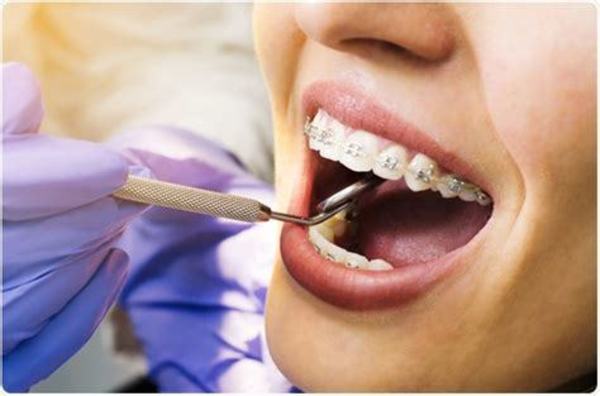 Сапфірові брекети: фото до і після лікування, установка систем на зуби Inspire Ice від Ormco, Radiance, лігатурні і самолігуючі