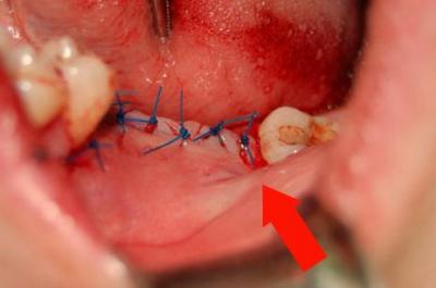Боляче знімати шви після видалення зуба, біль при витягу кореня, це викликає дискомфорт?