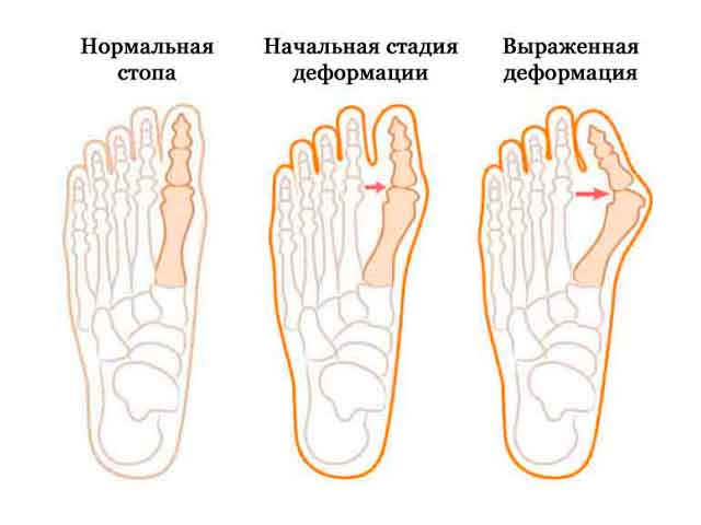Лікування кісточок на ногах народними засобами