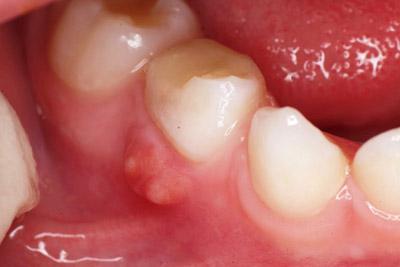 Зубний біль: причини, що таке код за МКХ 10, може від неї піднятися тиск, симптоми, наслідки, чому виникає