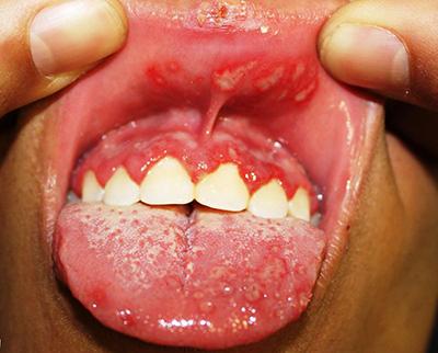 Як швидко вилікувати стоматит в домашніх умовах у дорослого у роті, лікування народними засобами, ніж лікувати і як позбутися