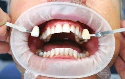 Чи шкідливо відбілювання зубів в стоматології чи ні: шкода і користь, за і проти, мінуси косметичних, пероксид карбаміду для емалі
