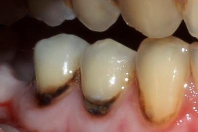 Карієс кореня зуба: що це таке, основні симптоми та код кореневого захворювання за МКБ 10, як його лікують