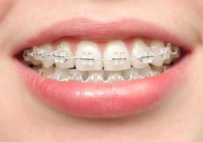 Які брекети краще ставити дорослому для вирівнювання зубів, варто в 30 років, чи можна після 40, за і проти, фото до і після