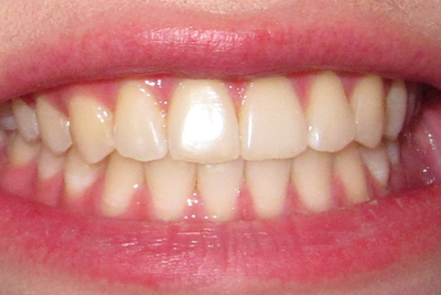 Зуби після брекетів: що ставлять і носять в життя, потрібні для закріплення художня реставрація, шинування і відбілювання