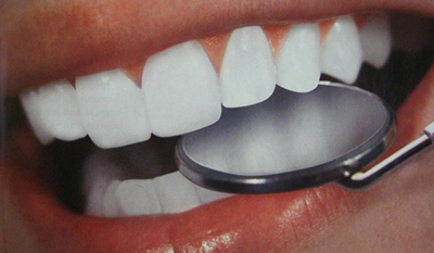 Відбілювання зубів в домашніх умовах: самий кращий спосіб, ніж можна відбілити, безпечний засіб і апарат відбілювати для будинку