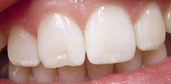 Карієс між зубами: контактний міжзубний, що це таке, причини виникнення між жувальними біля десни або на стику корінних