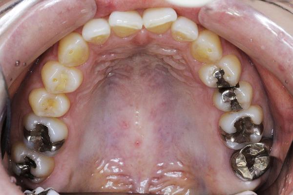 Множинний карієс: що робити, якщо багато уражених ділянок, чому не можна зволікати з лікуванням, як роблять чистку на всіх зубах