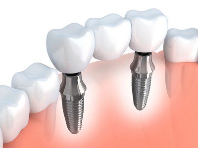 Імплантація зубів: знімок, який роблять перед операцією і для чого потрібен рентген імплантів зубів