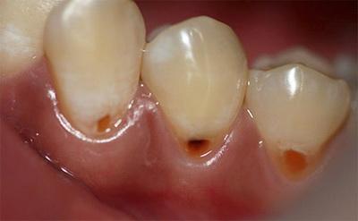 Карієс кореня зуба, лікувати або видаляти: лікування і пломбування, а також як лікують захворювання кореневе