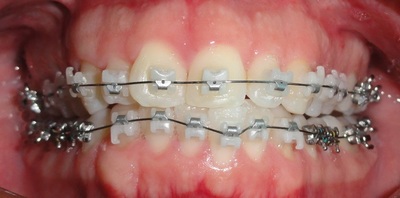 Які брекети краще ставити дорослому для вирівнювання зубів, варто в 30 років, чи можна після 40, за і проти, фото до і після