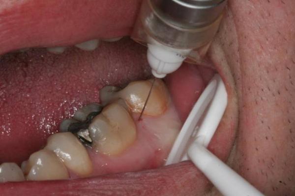 Видалення зуба без болю: безболісне витяг моляра мудрості, як безболісно видалити хворий різець