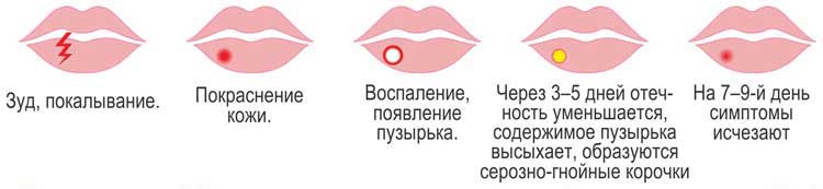 Лікування герпесу на губах народними засобами. Симптоми герпесу