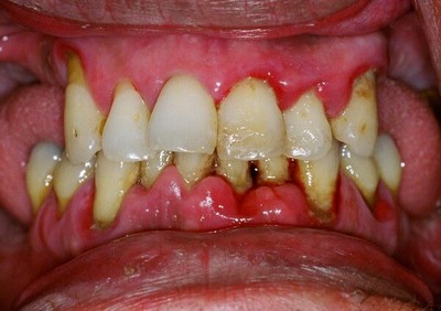Хронічний періодонтит: код МКХ 10, симптоми, видалення зуба, диференційна діагностика, клініка, гострий свищ, що це, форми