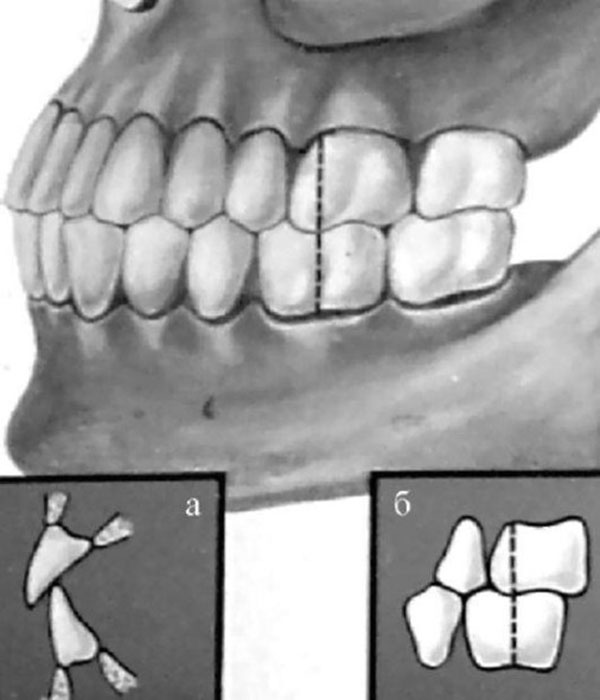 Правильний прикус зубів у людини: фото, якою має бути, що це таке, як виглядає нормальний і ідеальний, ніж визначити