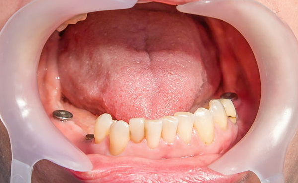 Формування ясна після імплантації зубів, що робити якщо формувач випав, розкриття та встановлення імпланта