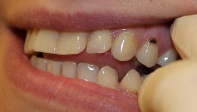 Карієс кореня зуба, лікувати або видаляти: лікування і пломбування, а також як лікують захворювання кореневе