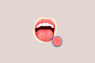 Як швидко вилікувати стоматит в домашніх умовах у дорослого у роті, лікування народними засобами, ніж лікувати і як позбутися