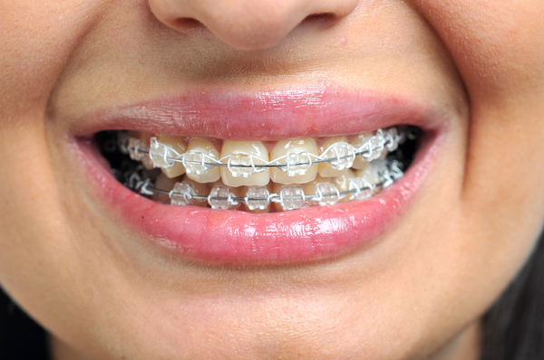Сапфірові брекети: фото до і після лікування, установка систем на зуби Inspire Ice від Ormco, Radiance, лігатурні і самолігуючі