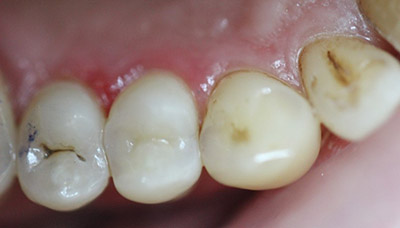 Поверхневий карієс зуба: код за МКХ 10, диференціальна діагностика, патогистология на поверхні, скарги при початковій формі