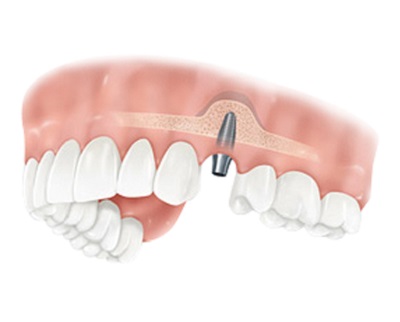 Формування ясна після імплантації зубів, що робити якщо формувач випав, розкриття та встановлення імпланта