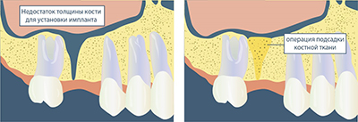 Синус ліфтинг та імплантація верхніх зубів одночасно: що це таке, його використання, закритий варіант, встановлення імпланта