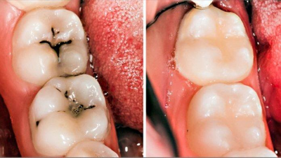 Фісурний карієс: що це, потрібно лікувати зуби, герметизація як профілактика, апарат для діагностики Аверон, лікування фісур