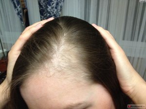 Що робити якщо лізуть волосся: правила догляду, які потрібно приймати вітаміни